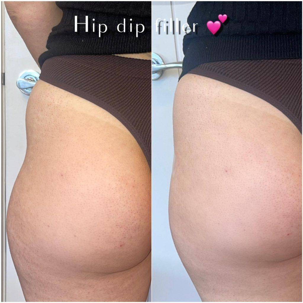 Hip Dip filler treatment by Cosmetic Doctors